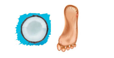 Aceite de coco para el mal olor de los pies